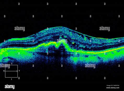 Afbeeldingsresultaten voor Optical Coherence Tomography
