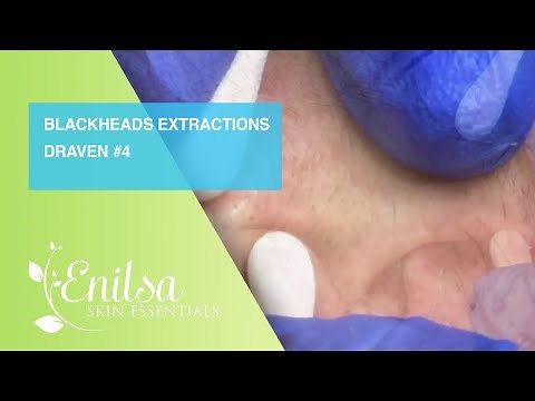 Blackheads Extractions Draven 4th Treatment