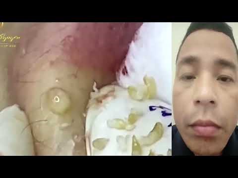 Extreme Acne & Pimple Popping Compilation – Blackhead & Cyst Removal