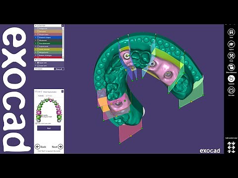 exocad Quick Guide: Implant Model