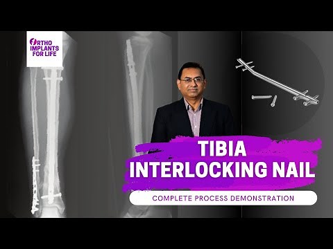 Tibia Interlocking Nail Complete Procedure