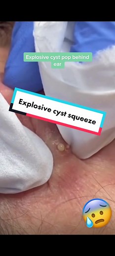 Crazy cyst explostion behind ear. #oddlysatisfying #whiteheadpimples #blackheadextraction #pimplepopperlover #extractions #dilatedporeofwiner