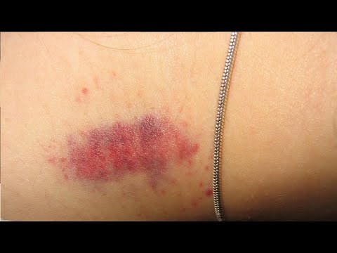 how to give someone a hickey easy step by step