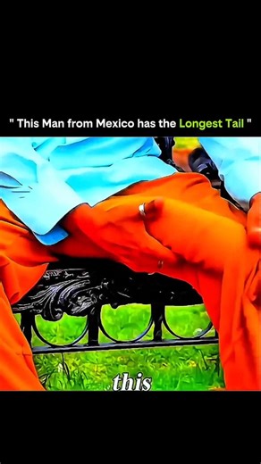 SCIENCE | FACTS | BEYOND | HISTORY | on Instagram: "It looks unbelievable, but it’s completely real. This rare condition, known as a true human tail, is a medical anomaly that occurs when embryonic development doesn’t fully regress structures present early in human growth. 🧠 During early development, all humans briefly form a tail-like structure. In extremely rare cases, it doesn’t disappear — resulting in a visible, tail-like extension at birth. Most are harmless, though some can be connected