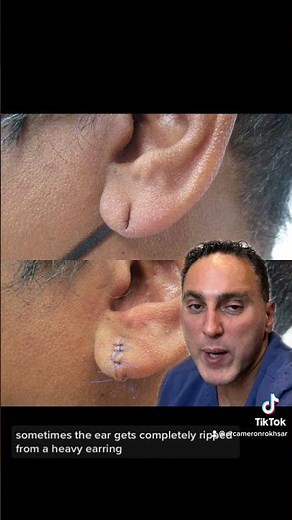 Earlobe Repair