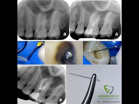 How to Break and Remove an Endodontic File - Dr. Andrei Ionescu