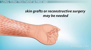 Grease Burns: Treatment & First Aid