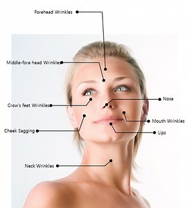 PDO Thread Lift - Simply One of The Best Treatments