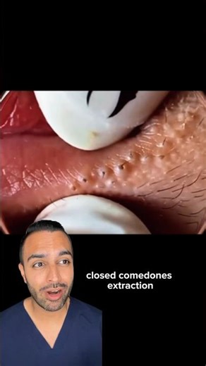 Your lip balm might be causing this! Blackheads removal | Dr Somji reacts