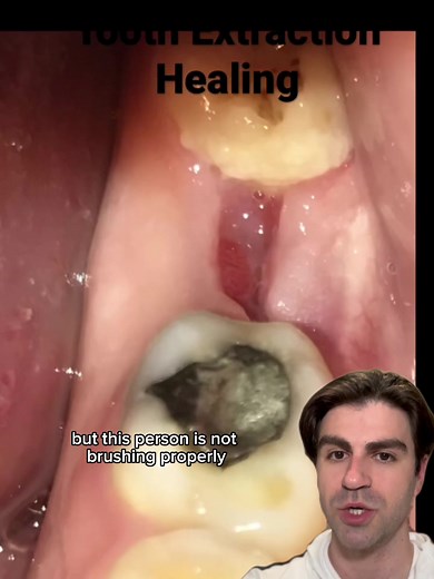 Gum Healing TimeLapse After Tooth Rem0val