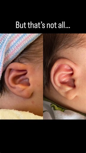 Ming Gray, MD, MPH on Instagram: "Teach a girl to fish 🎣! Thank you @drjosephjrousso for fixing Quincy’s ears and showing me how to pay it forward! Grateful for the sweetest patients and their parents. I love being able to provide the perspective of both parent and provider. Bc how else do you explain that the hardest part is seeing them lose a patch of their baby hair! 🥹 Did you know? In the first 6-8 weeks of a baby’s life, there is plenty of mom’s estrogen in baby’s body, which allows us to