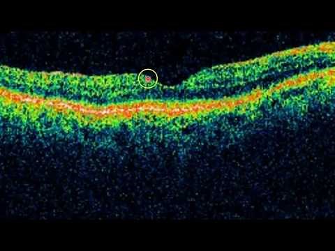 Mastering OCT Interpretation with Dr. Mark Friedberg