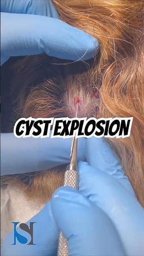 Cyst Explosion