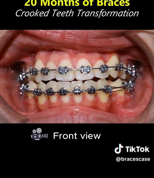 Fix crowded & crooked teeth -20 months braces journey #braces #dentalcare #orthodontics #beforeandafter