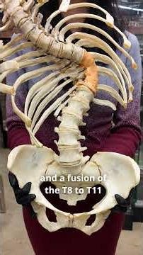 Scoliosis Explained: Different Types and Their Impacts