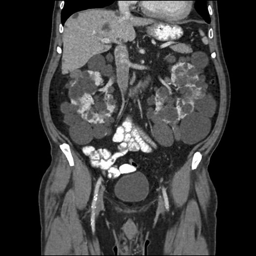 CT Scan of the Abdomen and Pelvis: With and Without Contrast