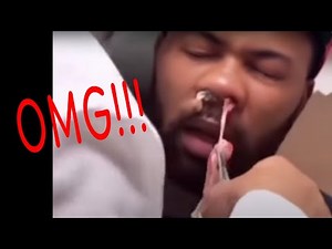 Cyst Pops & Explosions & Removal