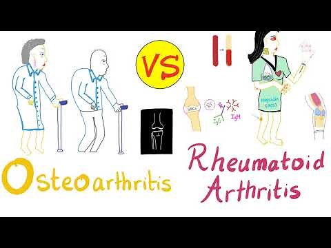 Rheumatoid Arthritis (RA) vs. Osteoarthritis (OA) - Rheumatology - Orthopedic Surgery