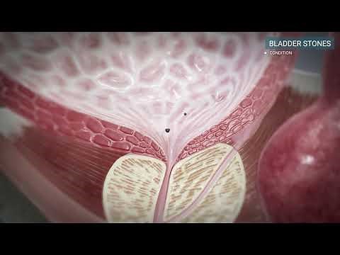 Urology. Bladder stones