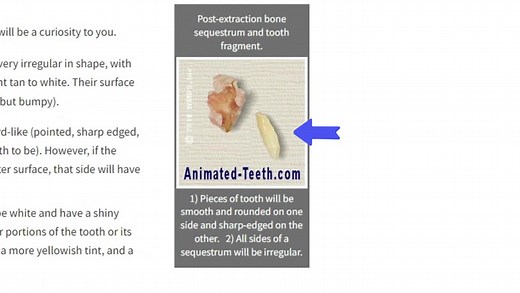 Post-Extraction Tooth and Bone Fragments: Causes | Removal