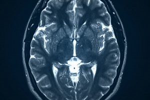 Brain Glioma Classification