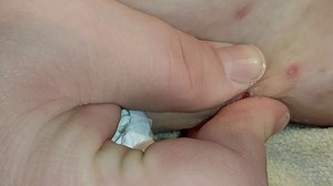 big-juicy-boils-exploding-full-of-pus