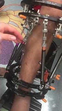 Taylor Spatial Frame turns