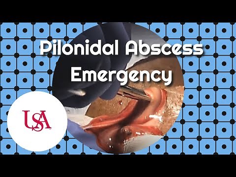 Pilonidal Abscess Emergency Incision & Drainage