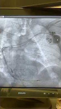 Dual chamber permanent pacemaker