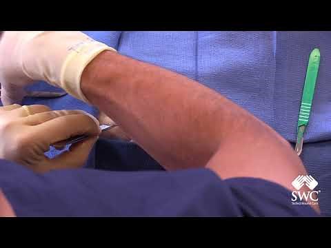 Incision and Drainage of Abscess