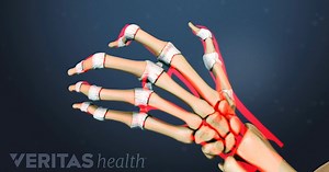 Hand Rheumatoid Arthritis Signs and Symptoms