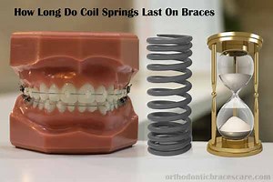 Coil Springs Braces: Types, Purpose, How Long They Last - Orthodontic Braces Care