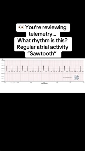 Recognizing Atrial Flutter: Quick and Effective Tips