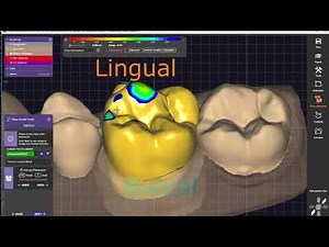 Exocad: Tutorial Episode #1