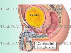 Urinary Bladder Injury Animation