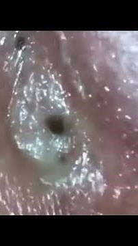 Popping Big Blackheads 😱
