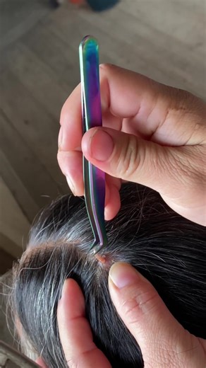 Extracción de gusano de monte: una experiencia impactante