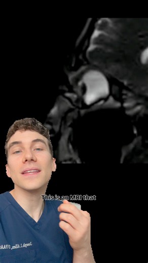 MRI of Eye Rubbing - Dangers You Never Knew About