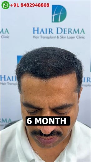 180 Days Amazing Hair Transplant Result & Cost In Pune #BaldnessSolution #NaturalHairline #haircare