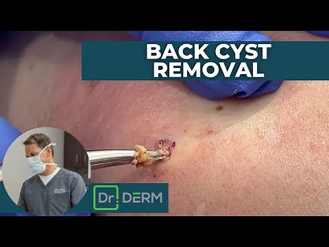 Back Cyst | Dr. Derm