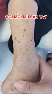 3.6K reactions · 224 shares | Kem Đồi Mồi ,Nám ,Tàn Nhang https://www.suckhoenhat.xyz/Drlichinhhang?utm_source=fb&utm_campaign=fb | Mỹ phẩm Nhật JP | Facebook