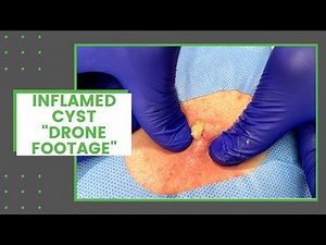 Inflamed Cyst "Drone Footage" | Dr. Derm