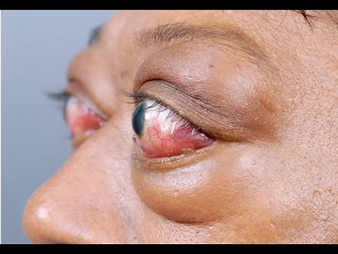 Bulging Eyes? it can be fixed!