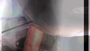 Open Reduction and Internal Fixation of a Medial Epicondyle Fracture