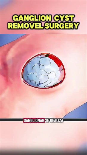 Ganglion Cyst Removal Surgery Explained with 3D Animation