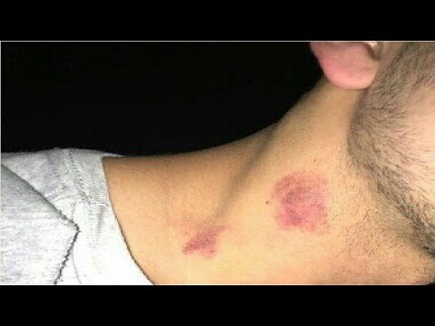 how to give a hickey for beginners easy