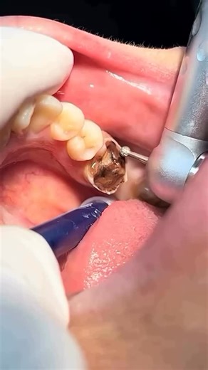 Dentistry Place on Instagram: "Caries Removal🤯 CREDIT: @matteo__negri 🔥 • Follow us @dentistryplace ❤️ . . . #dentistry #dentist #dental #restoration #endodontics"