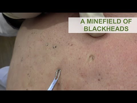A Minefield of Blackheads | Dr. Derm