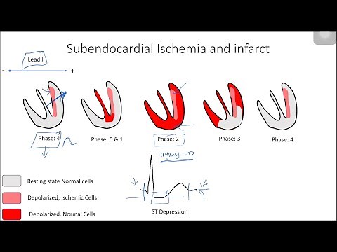 ST Elevation and Depression: Electrophysiological Basis