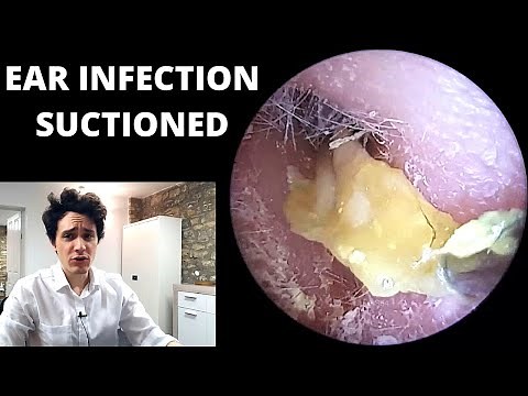 Pus and Dead Skin Suctioned From Ear Canal (Acute Otitis Externa)